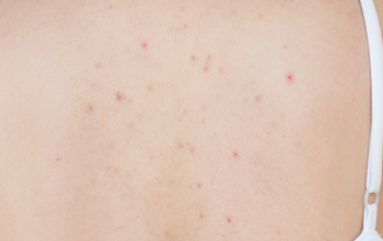 Điều Trị Mụn Body