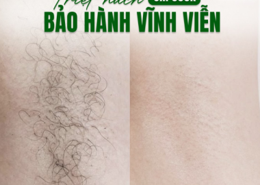 TRIỆT NÁCH CHỈ 999K BẢO HÀNH VĨNH VIỄN
