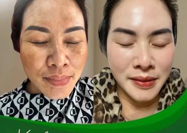 Khoá Học Chuyên Sâu Điều Trị Nám – Xoá Mờ Thâm Sạm, Lấy Lại Làn Da Trắng Sáng!