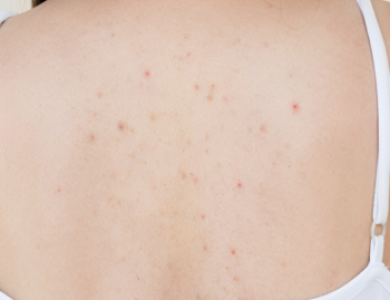 Điều Trị Mụn Body