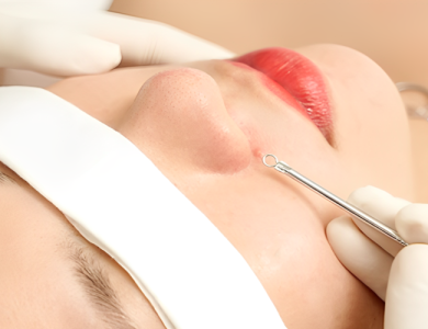 Bộ 3 Hoàn Hảo : Lấy Nhân Mụn + Peel + Ultrayoung Yag