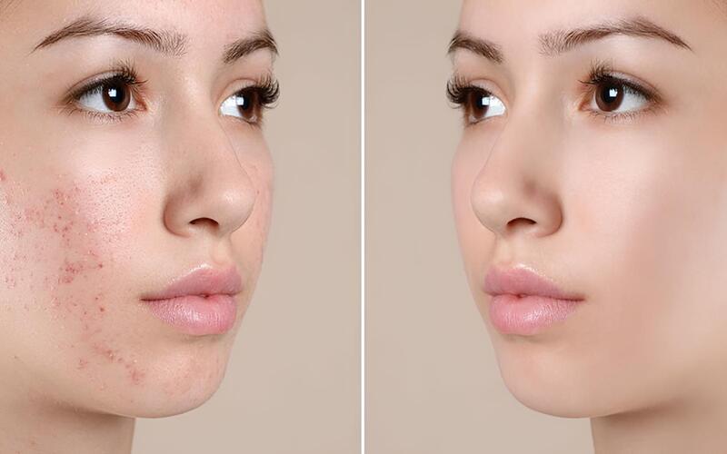 Peel Da Xóa Mụn – Giải Pháp Cho Làn Da Mụn & Thâm Sạm