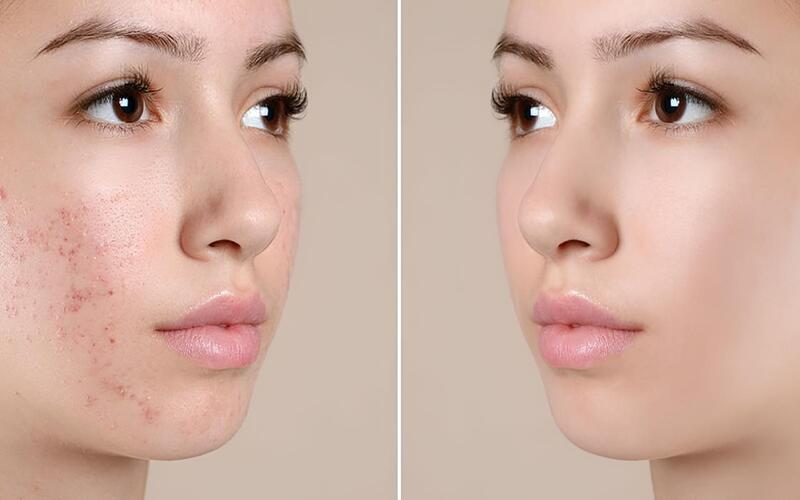 Chăm Da Chuyên Sâu – Điều Trị Các Vấn Đề Da Phổ Biến